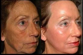 LASER CO2 FRAZIONATO - Risultato resurfacing