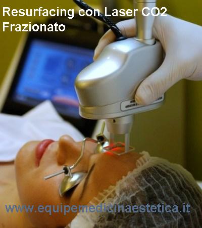 Laser CO2 frazionato - Equipe Medicina Estetica